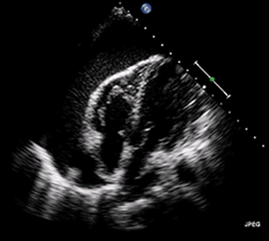 Échocardiographie montrant une tamponnade péricardique